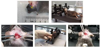 Modified Protocol for Establishment of Intracranial Arterial Dolichoectasia Model by Injection of Elastase Into Cerebellomedullary Cistern in Mice